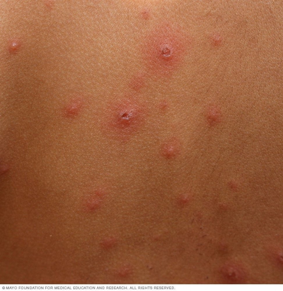 Chickenpox (Tetekuwanga)